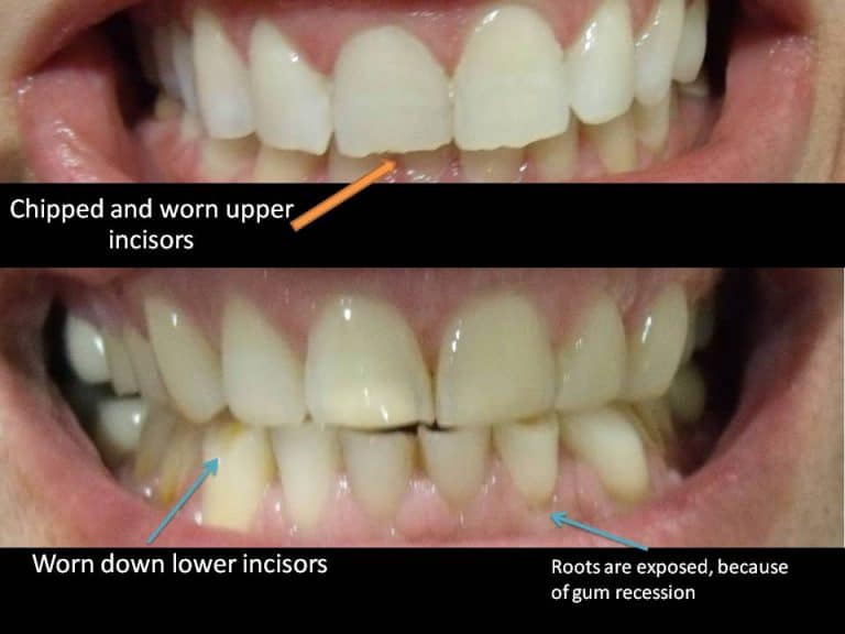 Signs & Symptoms of Bruxism (TMJ)