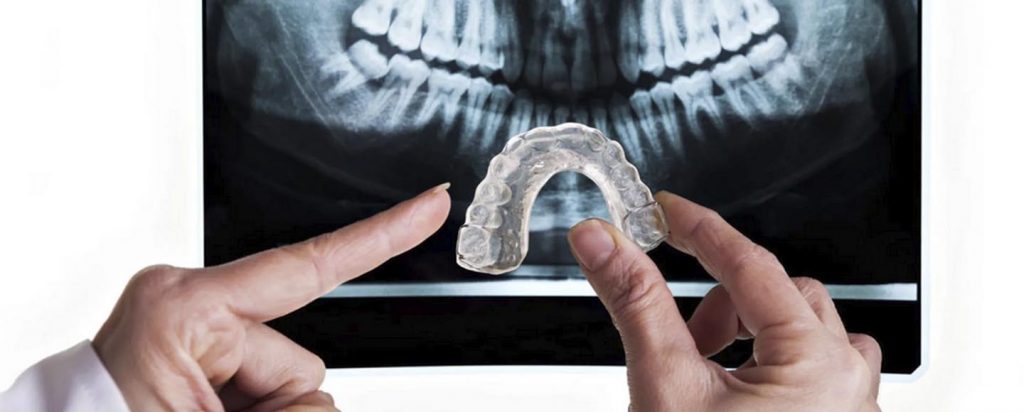 Armor Guard ProForm Mouthguard Review