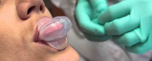 Read more about the article Tongue Retaining Devices: Do They Work for Sleep Apnea?
