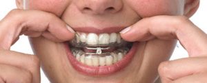 Read more about the article Best Mandibular Advancement Devices for Sleep Apnea (2026 Update)