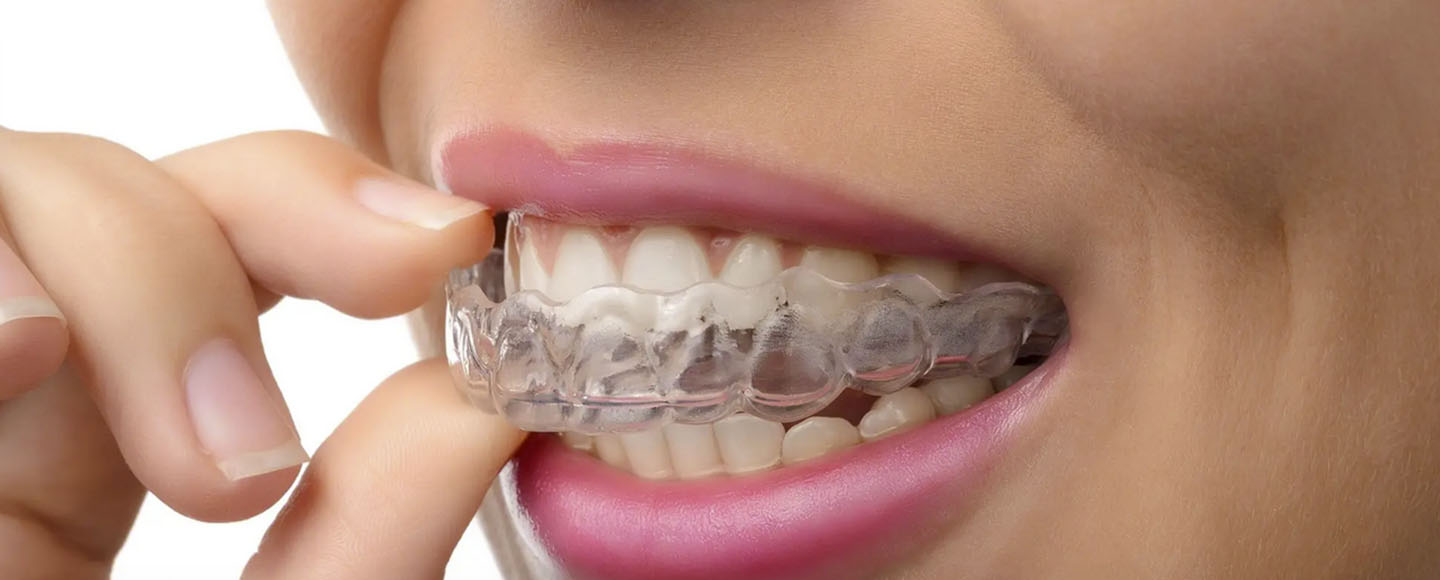 Best Over the Counter Mouth Guards for Teeth Grinding