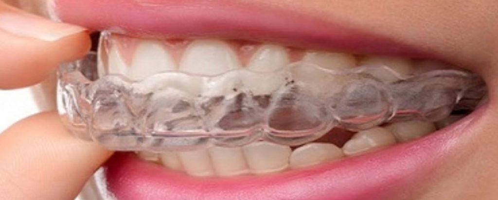 3 Alternatives to Night Guards for Bruxism