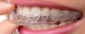 Read more about the article 3 Alternatives to Night Guards for Bruxism