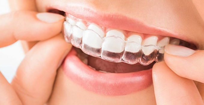 Can a Night Guard Shift Your Teeth?